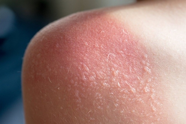 Cách khắc phục làn da bị cháy nắng